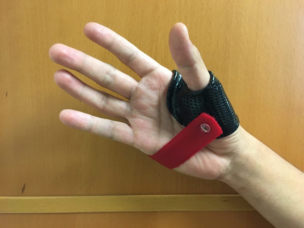 Custom thumb splint for hand therapy at Nick Rinard Physical Therapy