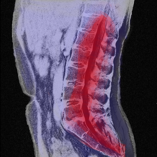 Xray highlighting region of severe back pain